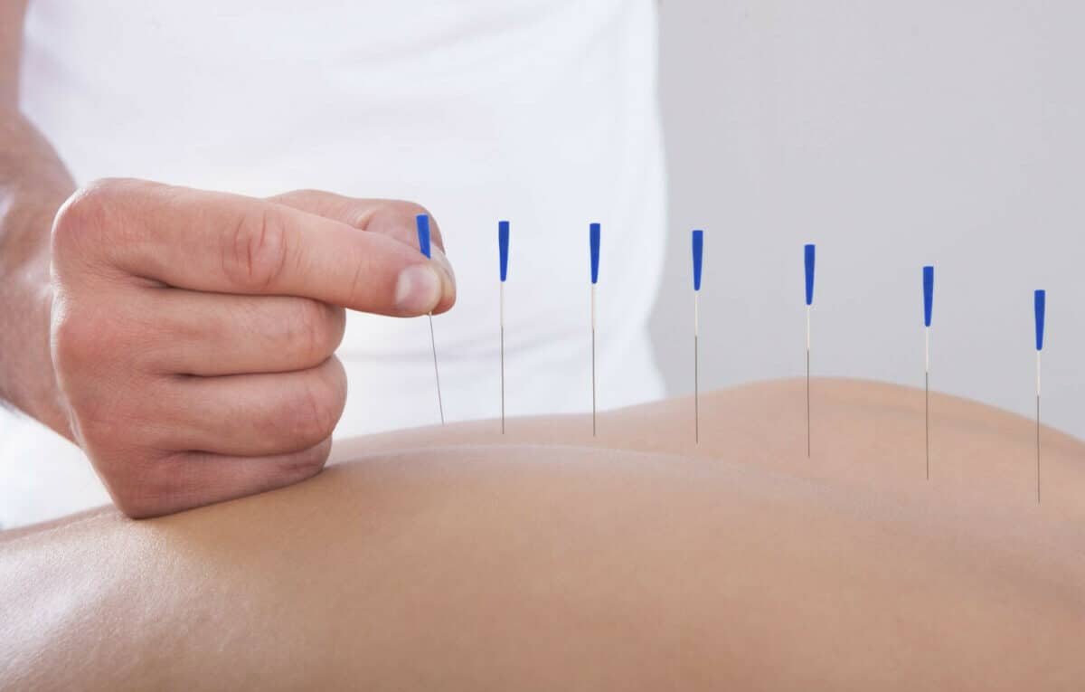 Une pratique d'acupuncture