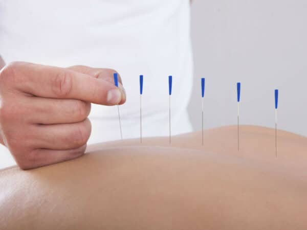 Une pratique d'acupuncture