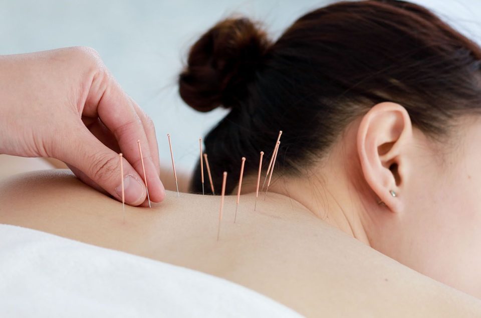 Une femme à l'acupuncture