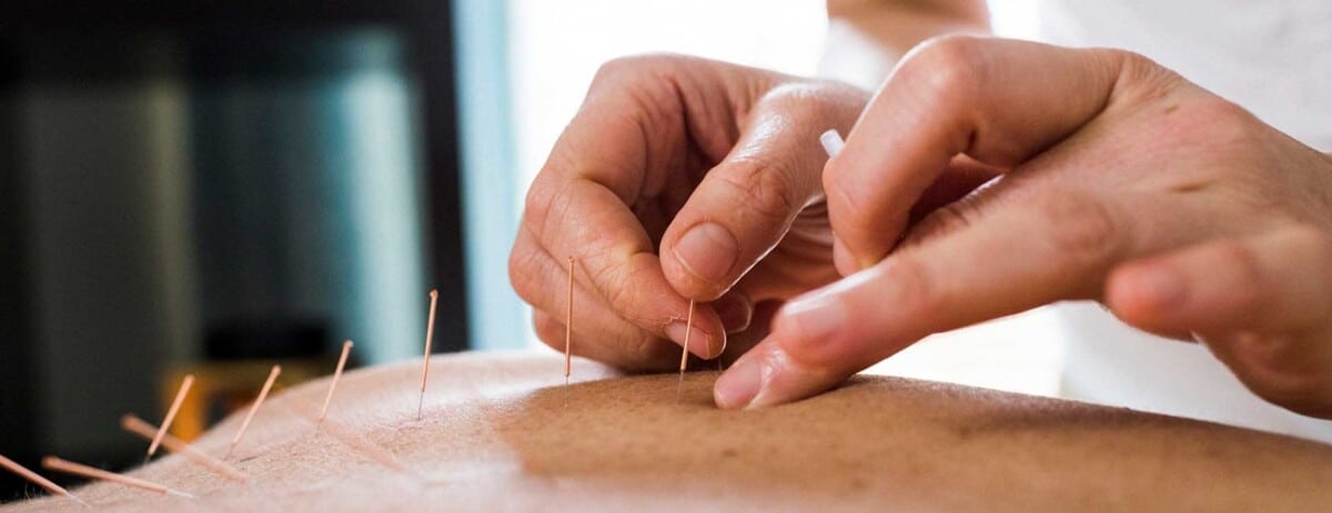 Une pratique de l'acupuncture 